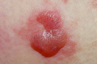 Pemphigoid